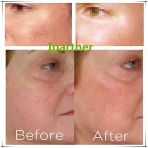 Laserul cu diode Ipartner LS980 eliberează sistemul de roșeață