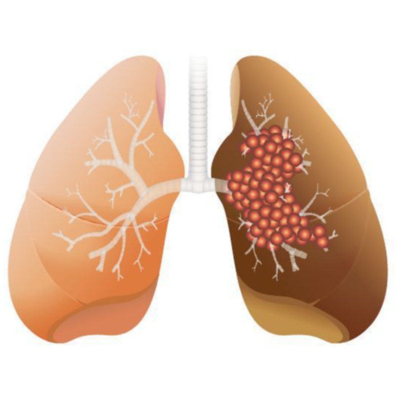 Doza mare de NMN inhibă creșterea adenocarcinomului pulmonar