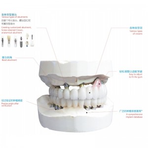 implant dentar